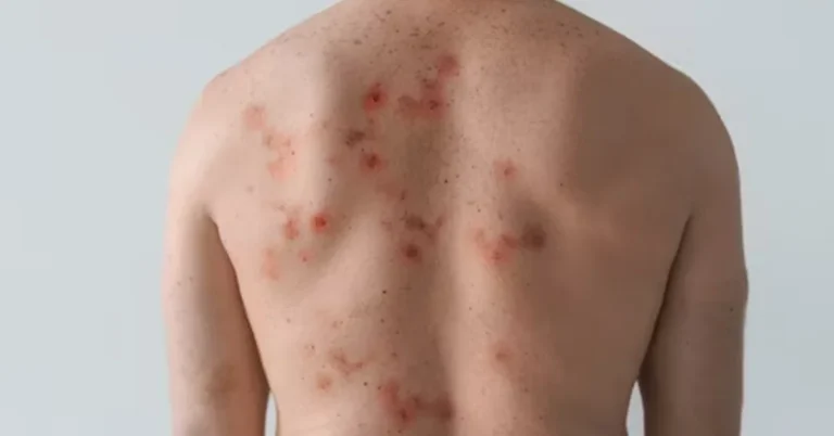 chicken pox scars